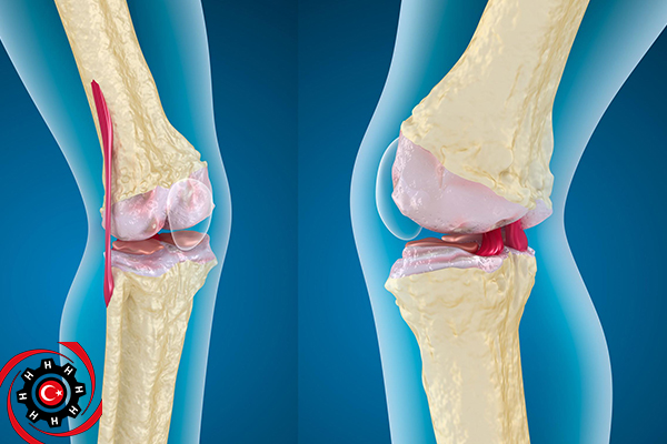 مخاطر جراحة استبدال مفصل الركبة