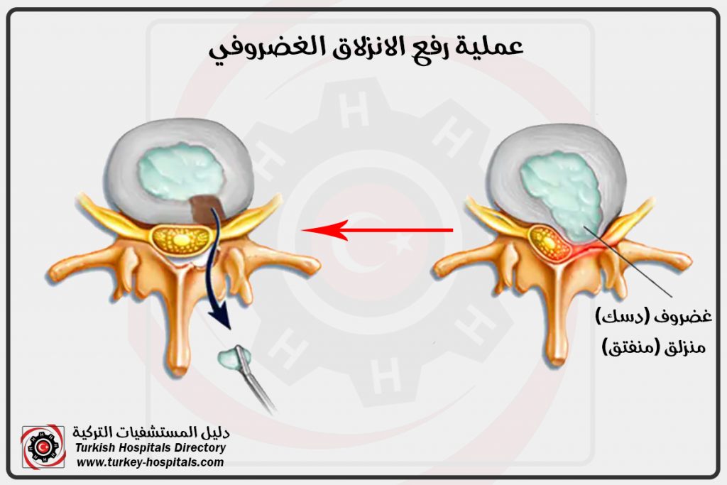 شفط الغضروف