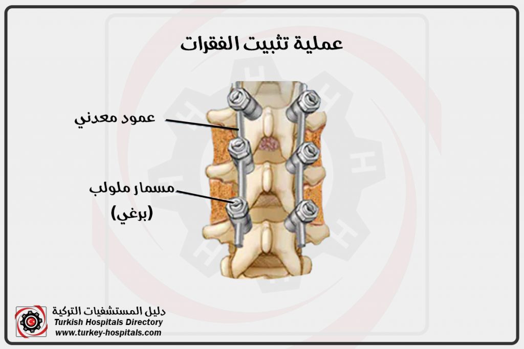 تثبيت الفقرات