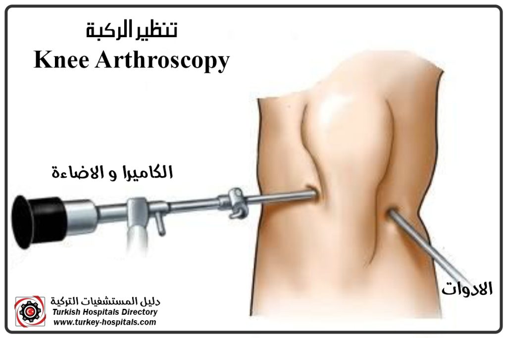 Arthroscopy