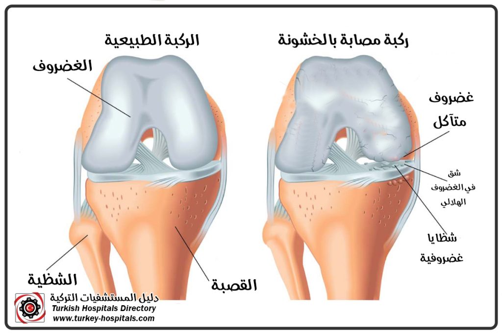 خشونة الركبة 